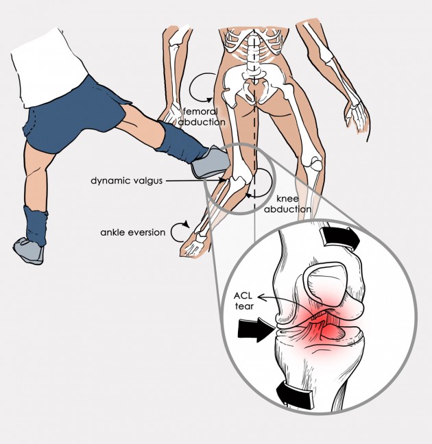 LOWER LIMB SUPPORT ATOM/2RA